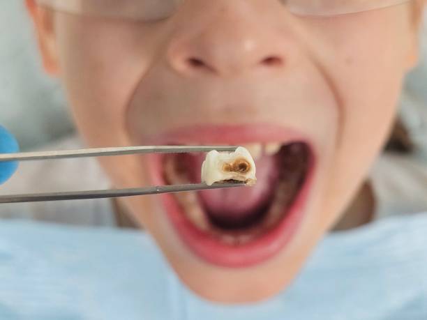 Best Emergency Broken Tooth Repair in Belton, TX